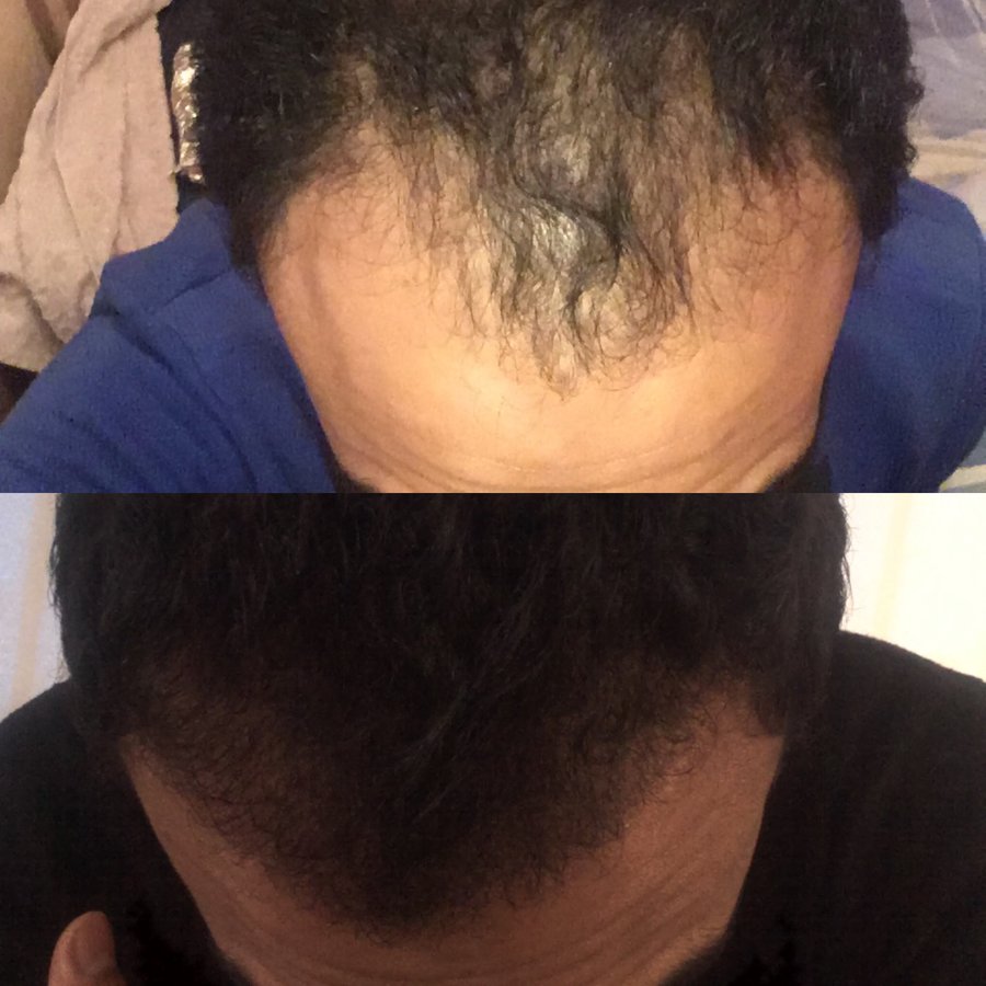 Civas Hair Transplant — photo 3