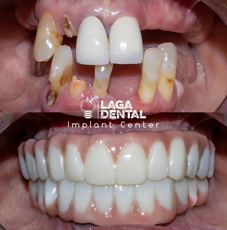 Laga Dental Implant Center