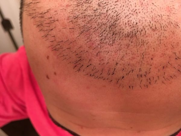 Hair Transplant